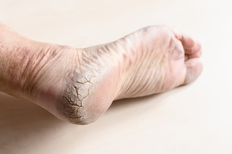 Dead Dry Cracked Skin on Heel of Male Foot